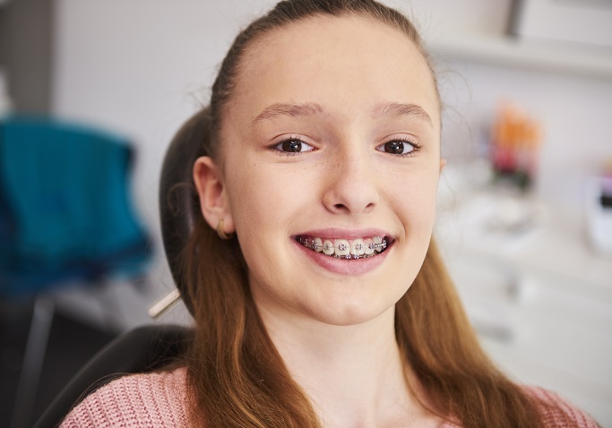 Брекеты – по суперцене!