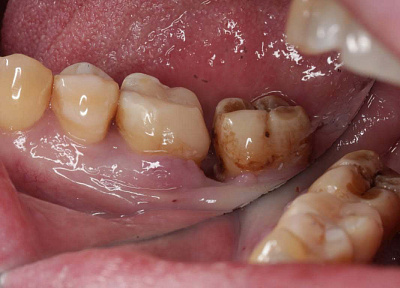 Установка коронки на зуб