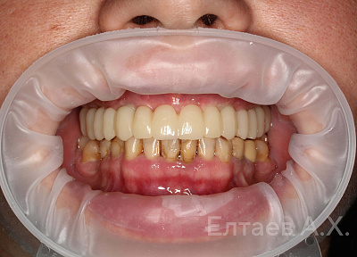 Установка коронок на импланты