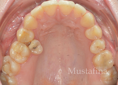 Лечение на брекет-системе – дистализация с минивинтом