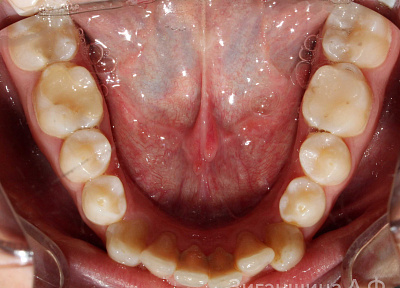 Лечение на брекет-системе
