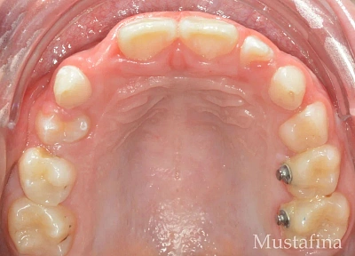 Лечение на элайнерах