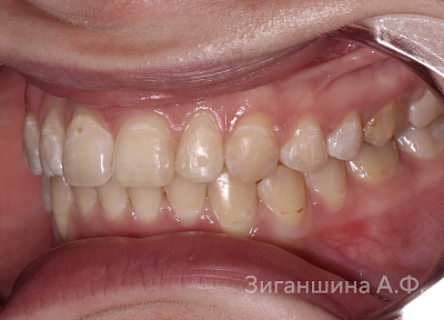 Лечение на съемных пластинках с переходом на брекет-систему