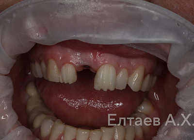 Виниры и коронка на имплант