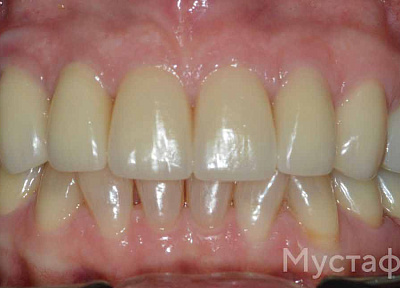 Установка коронки на импланте