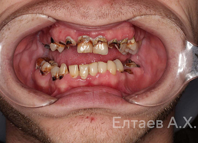 Установка коронок на зубы