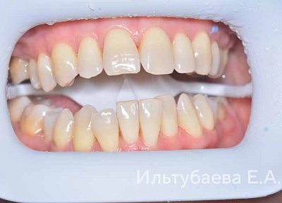 Отбеливание зубов