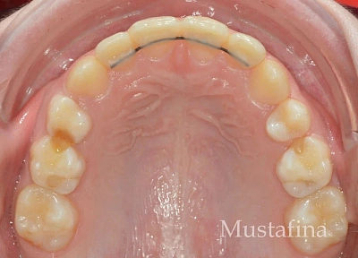 Лечение на элайнерах – коррекция центральной линии