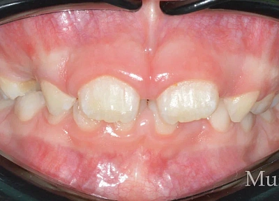 Лечение на элайнерах