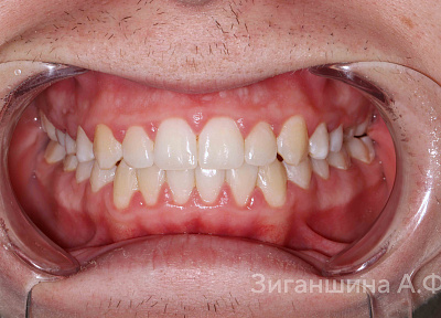 Лечение на брекет-системе