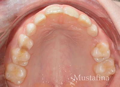 Лечение на элайнерах – коррекция центральной линии