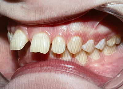 Лечение на съемных пластинках с переходом на брекет-систему срок лечения 2 года