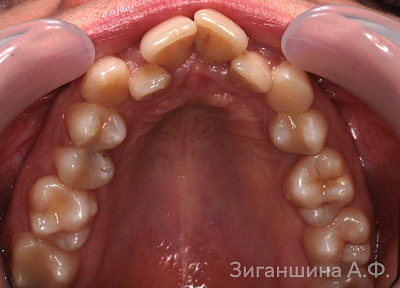 Лечение на брекет-системе