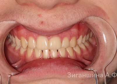 Лечение на брекет-системе