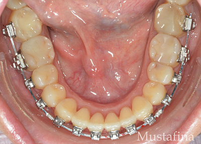 Лечение на брекет-системе – рецессии
