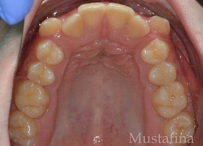 Лечение на брекет-системе – дефицит места