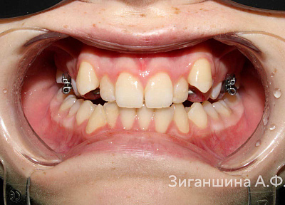 Лечение на аппарате для расширения верхнего зубного ряда с переходом на брекет-систему