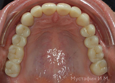 Установка коронки на импланте