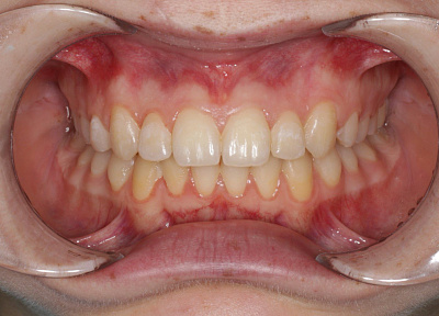 Лечение на аппарате для расширения верхнего зубного ряда с переходом на брекет-систему