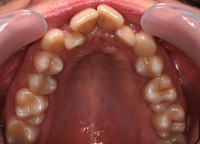 Лечение на брекет системе