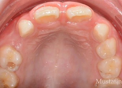 Лечение на элайнерах