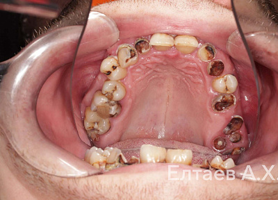 Установка коронок на зубы