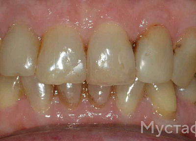 Установка коронки на импланте