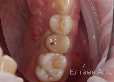 Установка коронки на зуб