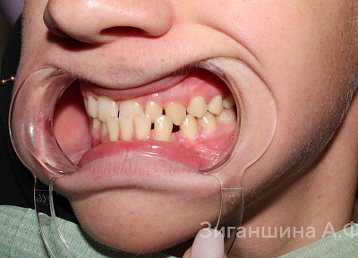 Лечение на брекет-системе