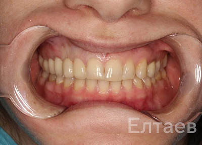 Установка коронок на зубы