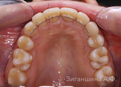 Лечение на брекет-системе