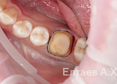 Установка коронки на зуб
