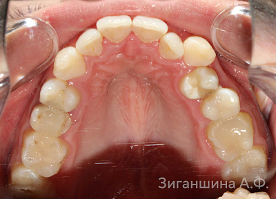 Лечение на брекет-системе