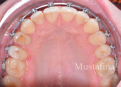 Лечение на брекет-системе – дистализация с минивинтом