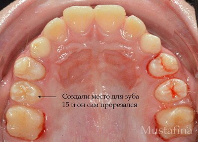 Лечение на брекет-системе – дефицит места