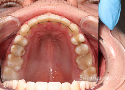 Лечение на брекет-системе