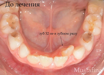 Лечение на элайнерах