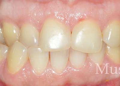 Лечение на элайнерах