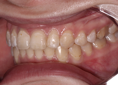 Лечение на съемных пластинках с переходом на брекет-систему срок лечения 2 года