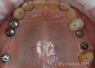 Установка коронки на импланте