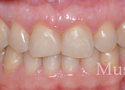 Лечение на элайнерах