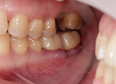 Установка коронки на зуб