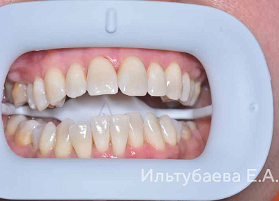 Отбеливание зубов