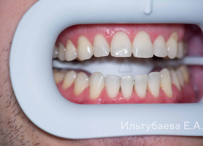 Отбеливание зубов