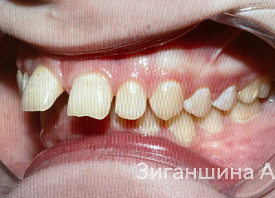 Лечение на съемных пластинках с переходом на брекет-систему