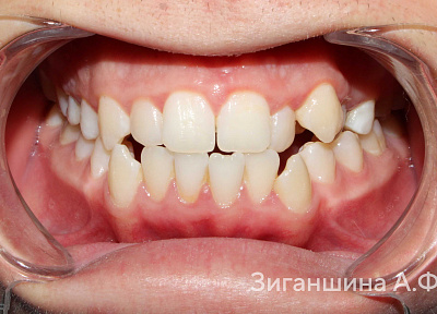 Лечение на брекет-системе