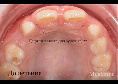 Лечение на элайнерах