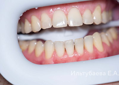 Отбеливание зубов