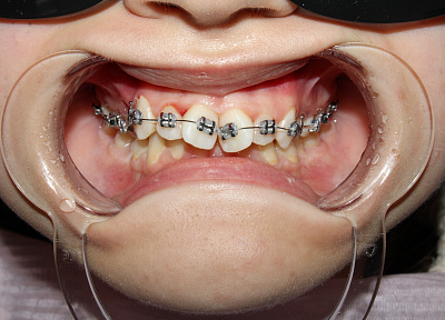 Исправление прикуса брекетами