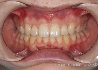 Лечение на аппарате для расширения верхнего зубного ряда с переходом на брекет-систему